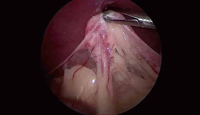 Trocar & Cannula — Standard — ETG ASSURE